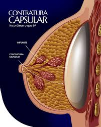 Contratura Capsular